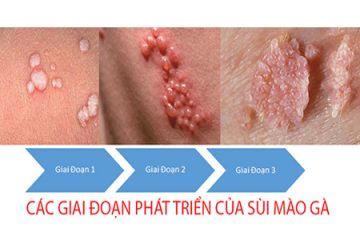 Bệnh Sùi Mào Gà Ở Nữ Giai Đoạn Đầu