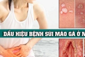 DẤU HIỆU SÙI MÀO GÀ Ở NỮ, CHỮA SÙI MÀO GÀ BẰNG PHƯƠNG PHÁP ALA – PDT TIÊN TIẾN KHÔNG ĐAU, LOẠI BỎ 100% SÙI MÀO GÀ VÀ KHÔNG BỊ TRỞ LẠI