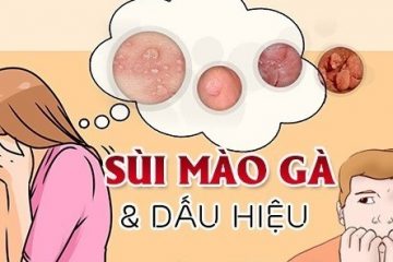 TOP 3 ĐỊA CHỈ CHUYÊN CHỮA SÙI MÀO GÀ ĐƯỢC ĐÁNH GIÁ UY TÍN HÀ NỘI