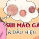 THUỐC TRỊ SÙI MÀO GÀ