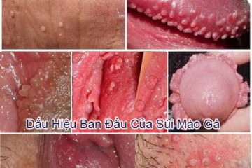 Hỗ Trợ Loại Bỏ 100% Sùi Mào Gà Bằng Phương Pháp ALA_PDT Tiên Tiến